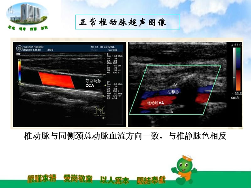 锁骨下动脉盗血;.ppt_第3页