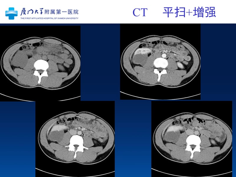 多房性囊性肾细胞癌;.ppt_第3页