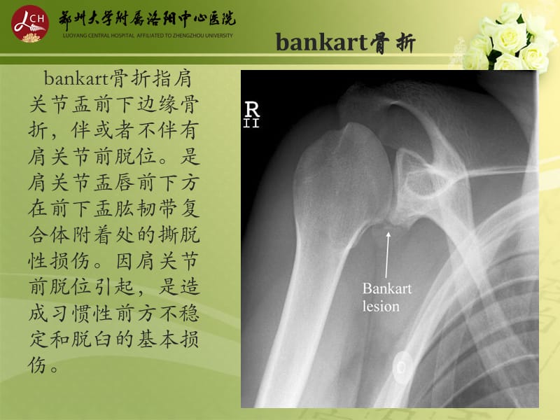 特殊类型骨折;.ppt_第2页