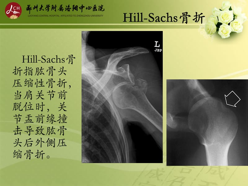 特殊类型骨折;.ppt_第3页