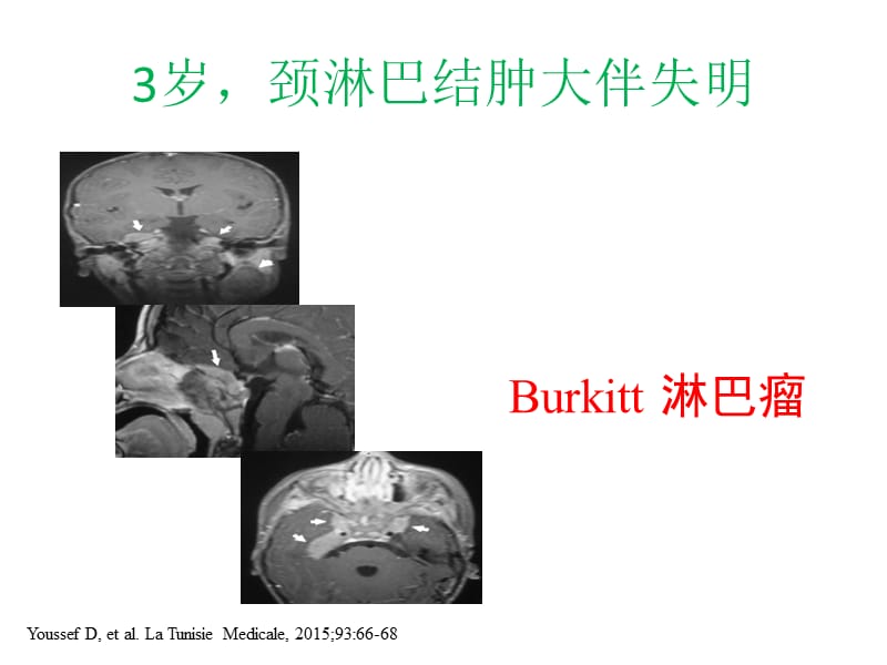 小儿颈部淋巴结;.ppt_第2页