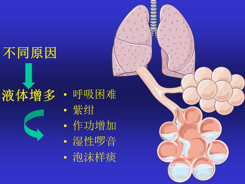 围术期急性肺水肿;.ppt_第3页