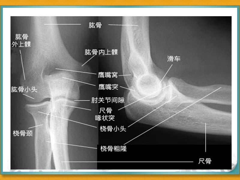 肘关节脱位ppt;.ppt_第2页