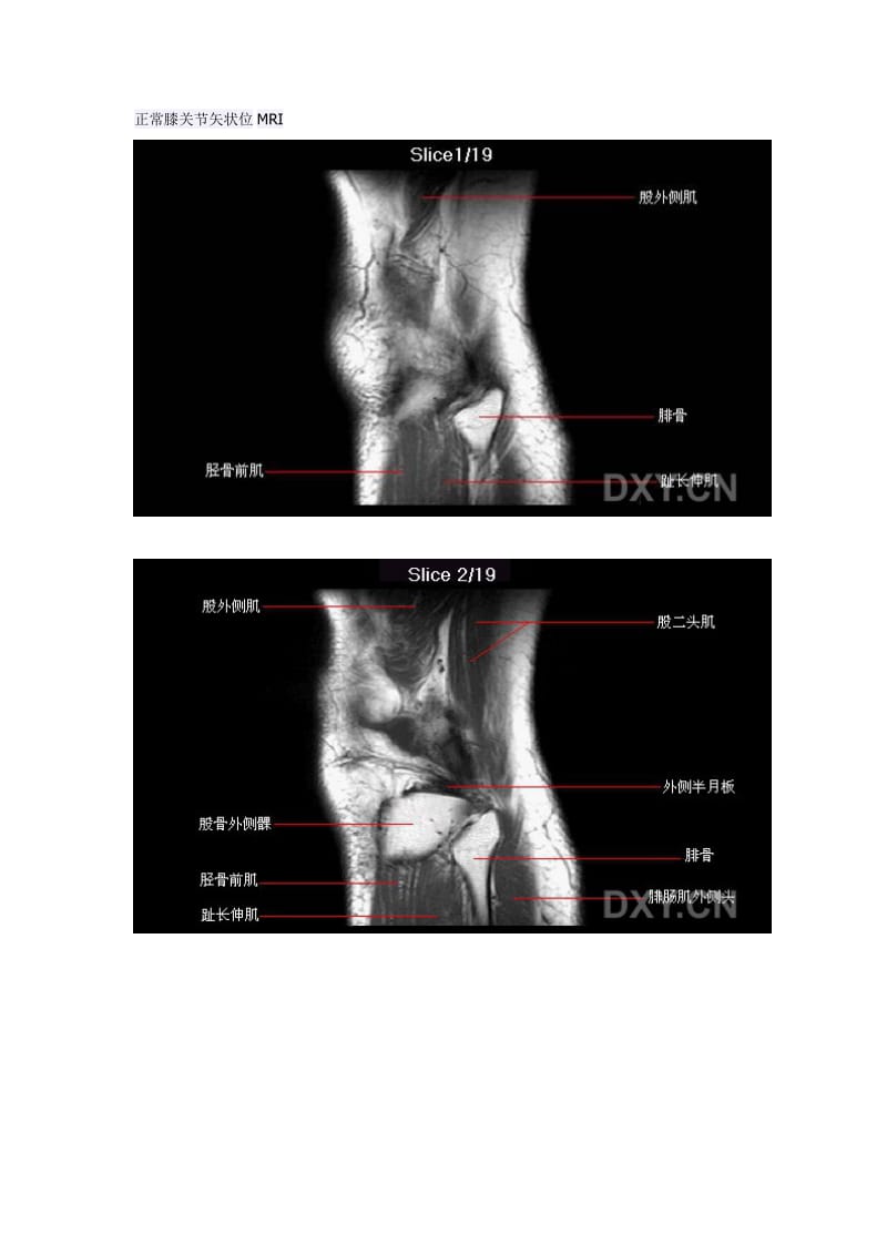 正常膝关节MRI(矢,冠,轴位图);.docx_第1页