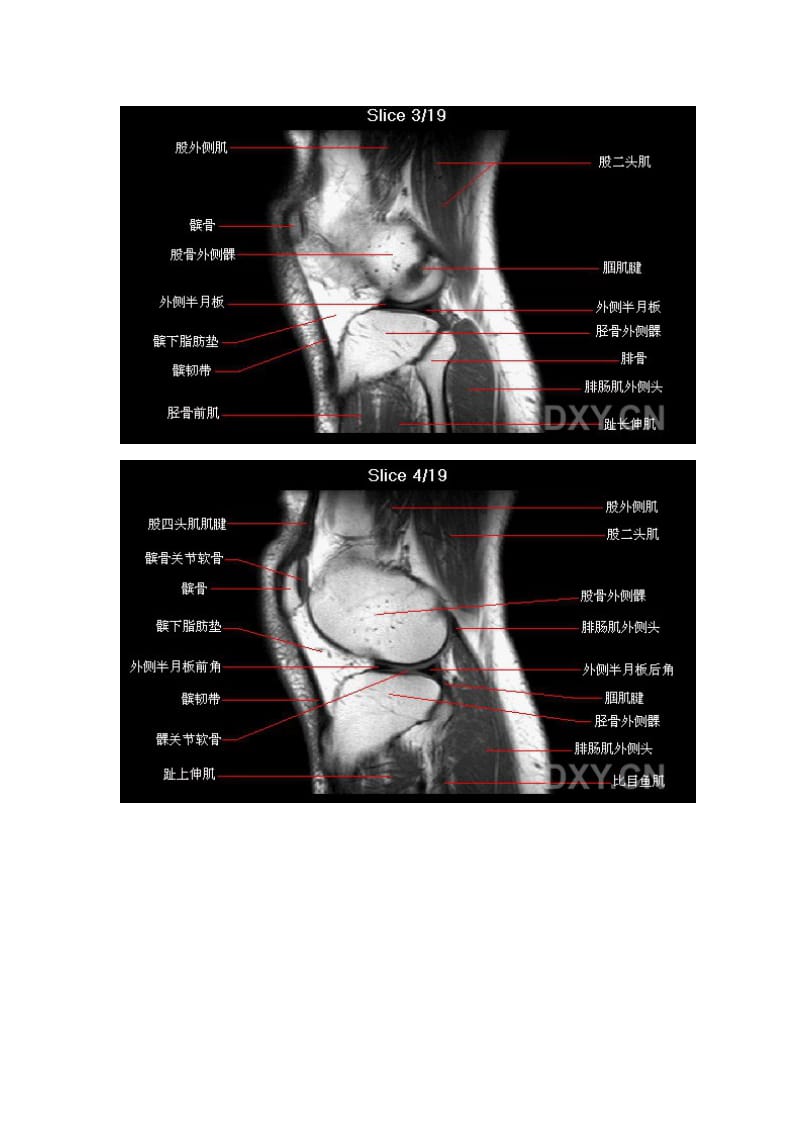 正常膝关节MRI(矢,冠,轴位图);.docx_第2页