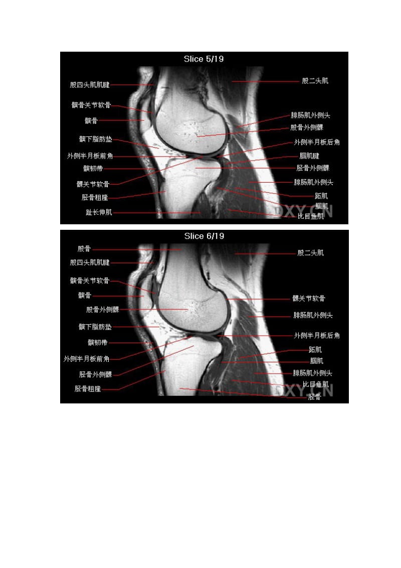 正常膝关节MRI(矢,冠,轴位图);.docx_第3页