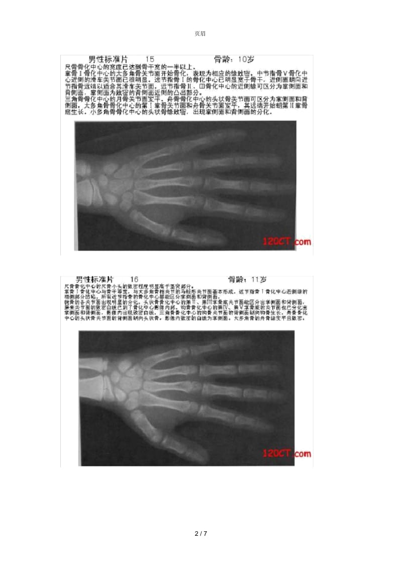 标准骨龄片.docx_第2页