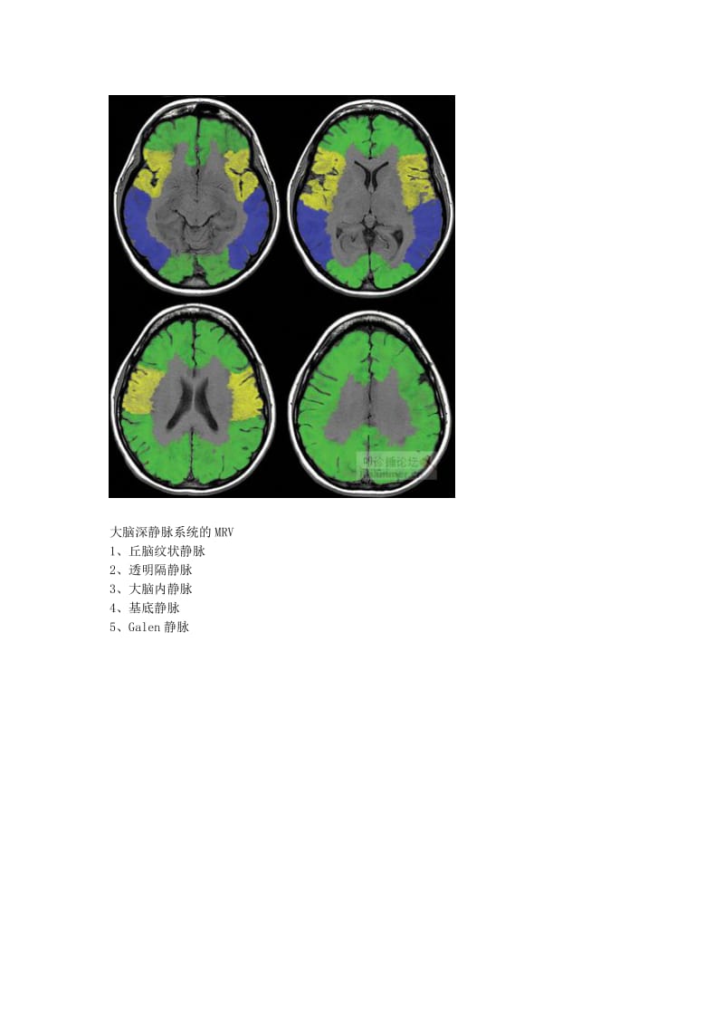 大脑的静脉系统(MRV);.docx_第3页