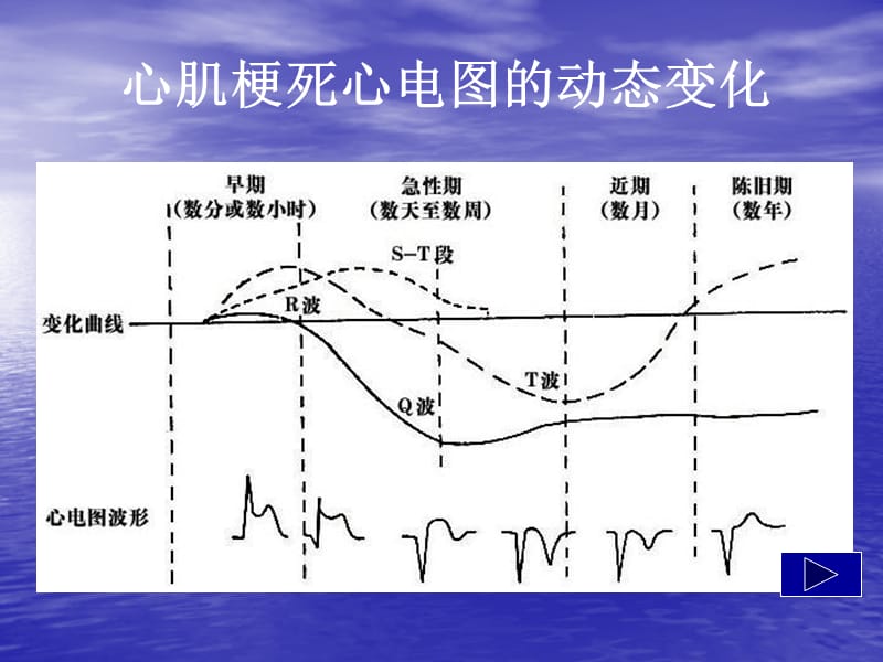 心肌梗死心电图的动态变化;.ppt_第1页