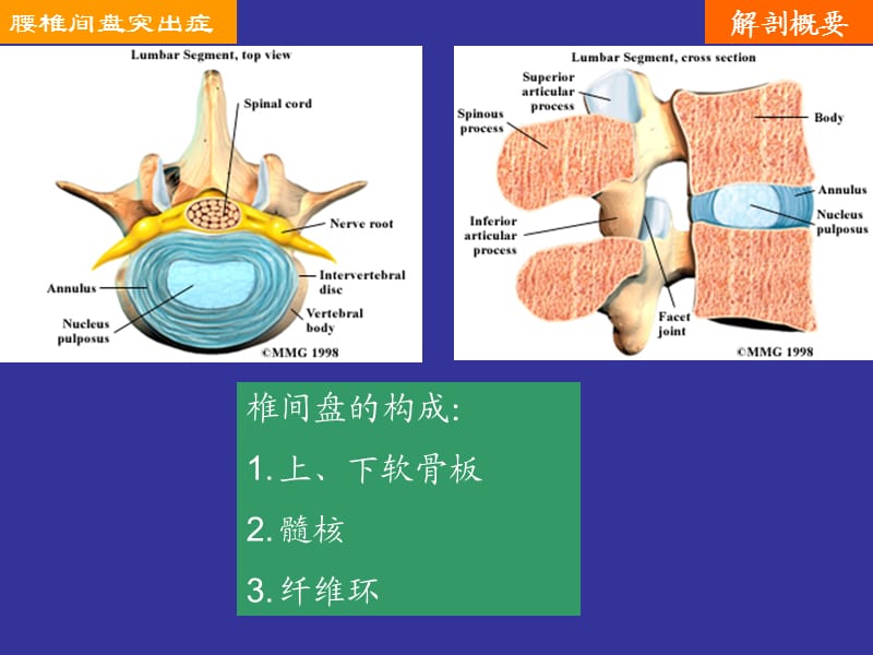 腰椎间盘突出症教学课件.ppt_第3页