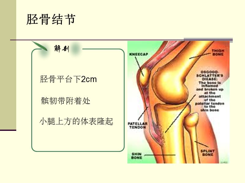 胫骨结节骨软骨炎(OSD).ppt_第3页