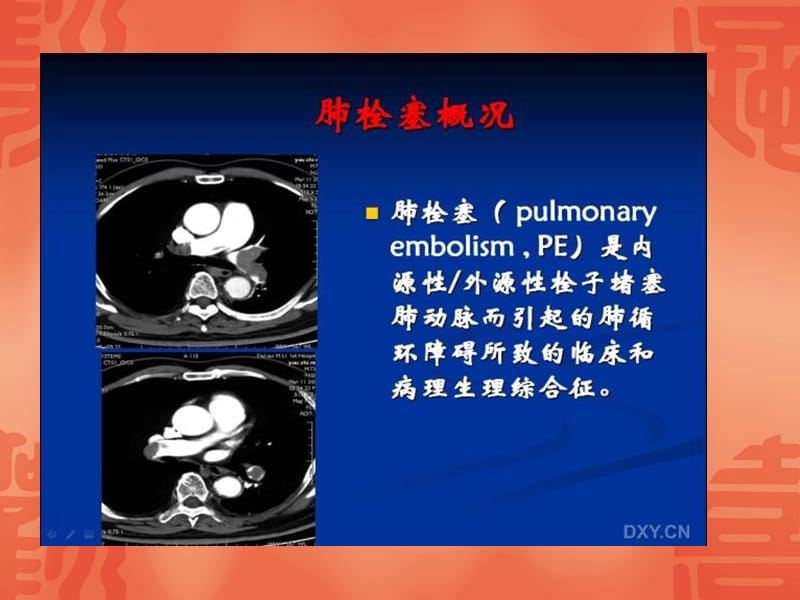 肺动脉栓塞CTA;.ppt_第2页