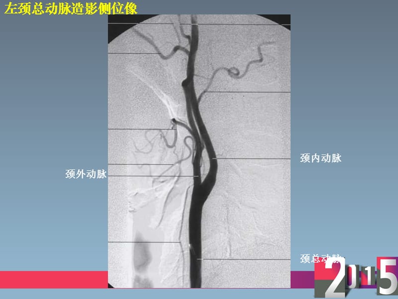 颈内动脉分段与图解.ppt_第3页