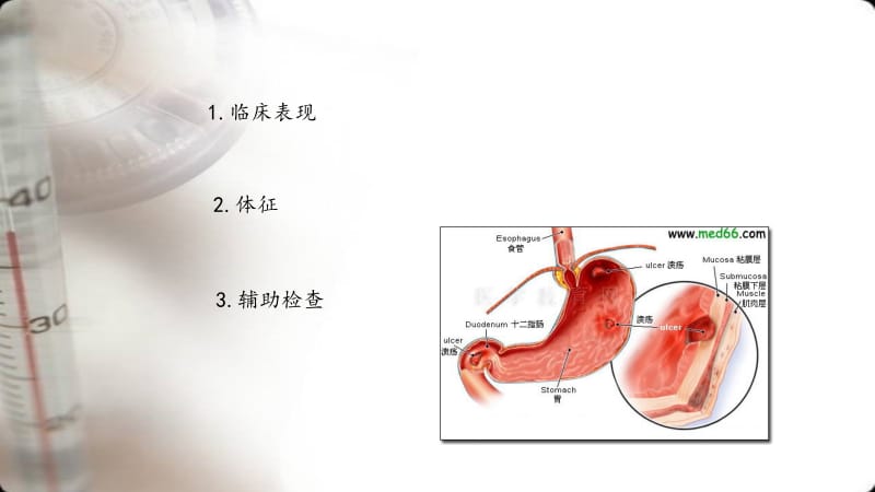 消化性溃疡的诊断与鉴别诊断.pptx_第3页