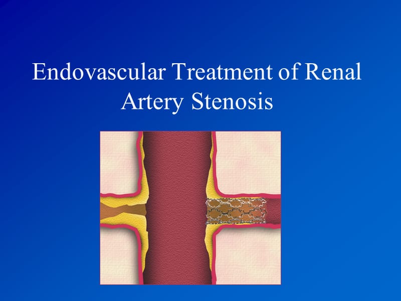 肾动脉支架植入术图文详解;.ppt_第1页