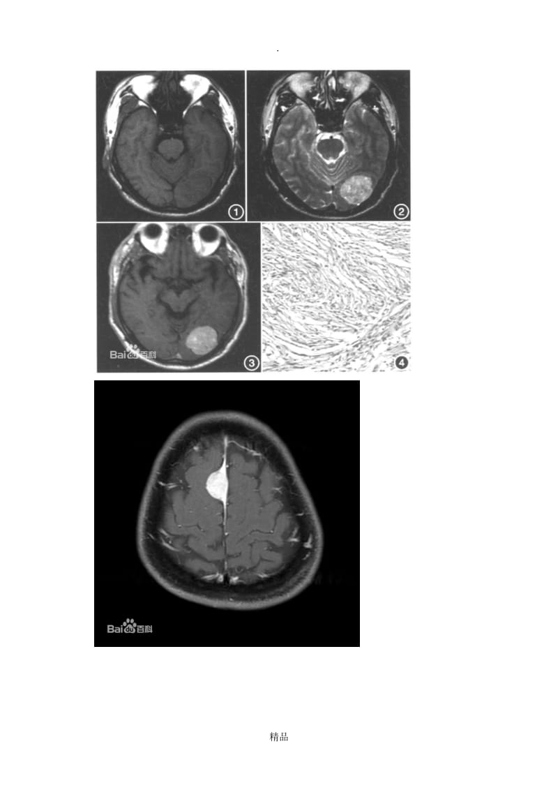 脑膜尾征--脑膜瘤图片.doc_第3页