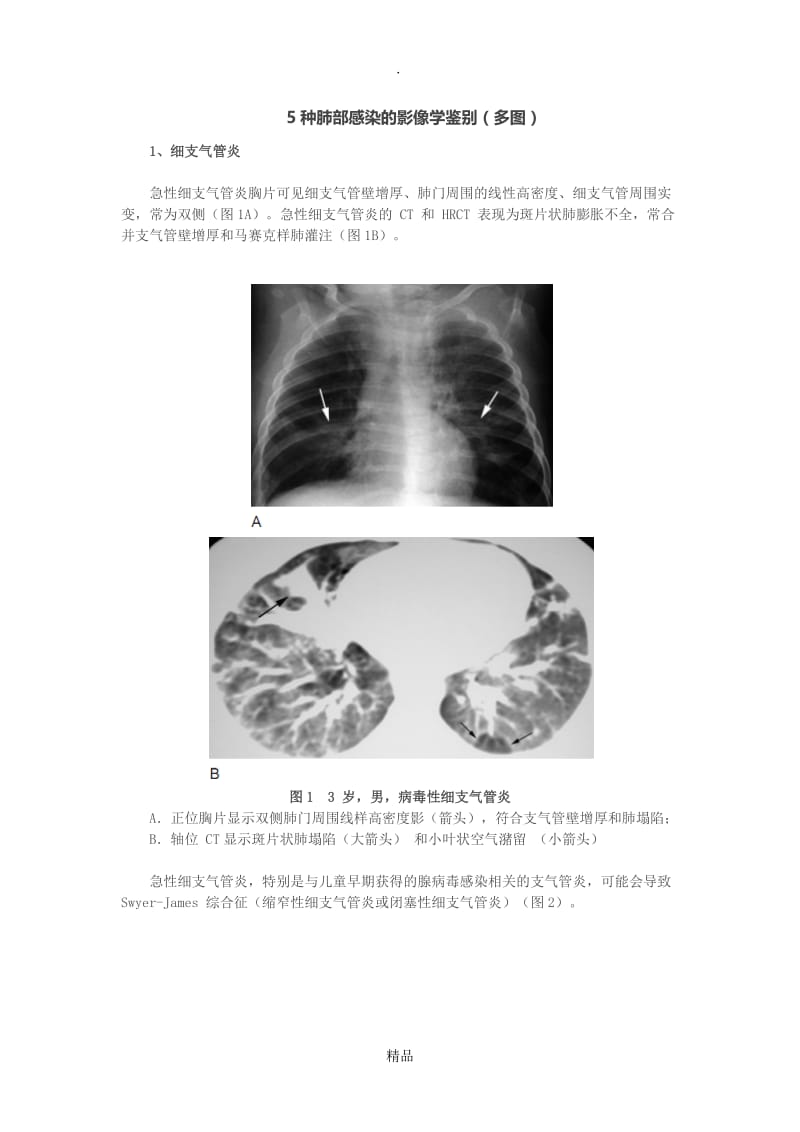 5种肺部感染的影像学鉴别(多图).doc_第1页