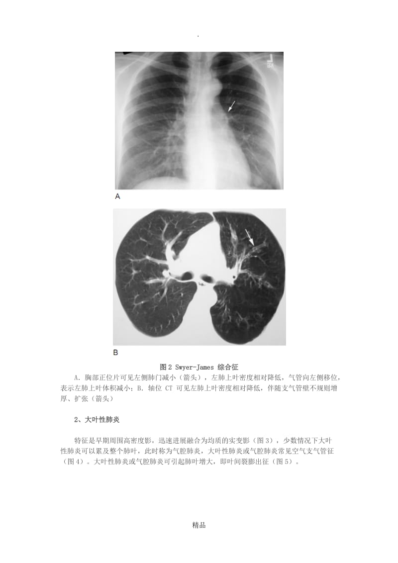 5种肺部感染的影像学鉴别(多图).doc_第2页