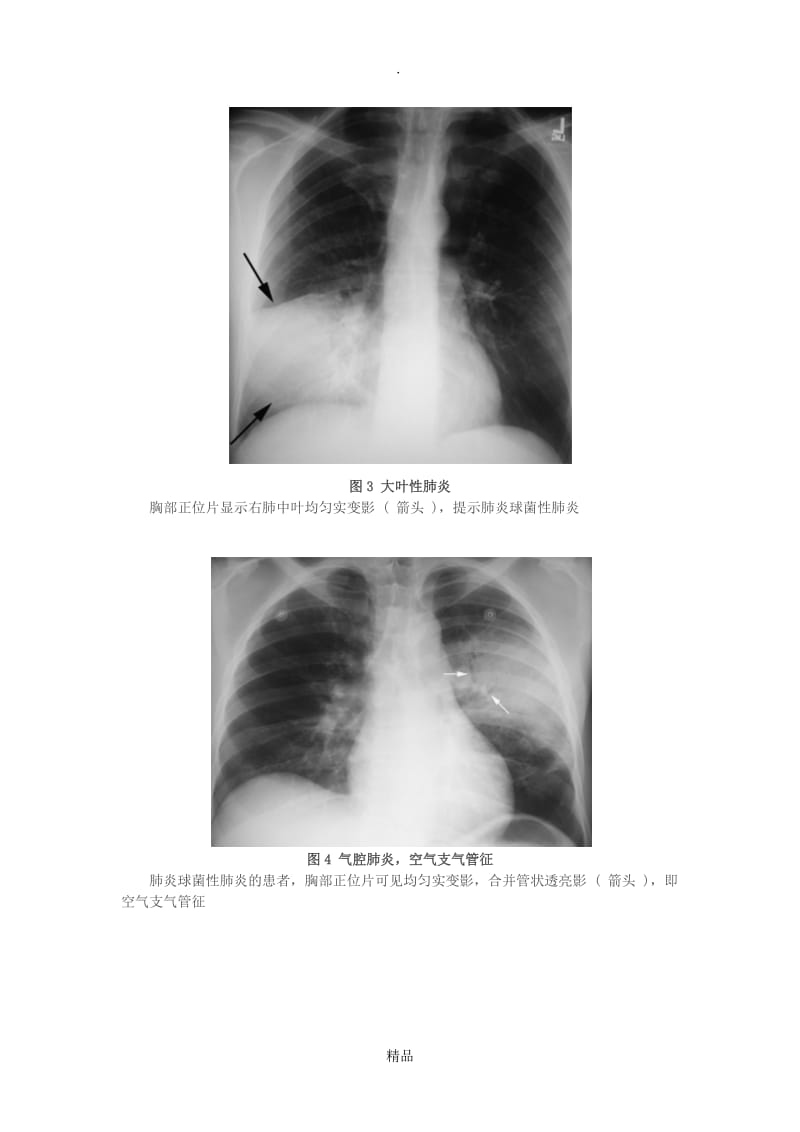 5种肺部感染的影像学鉴别(多图).doc_第3页