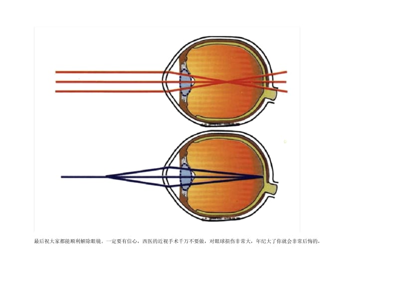 高度近视也不用带眼镜了(经典珍藏版).docx_第3页