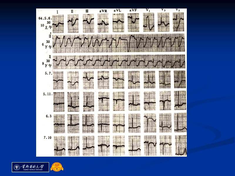 儿童心肌炎-冀石梅.ppt_第3页