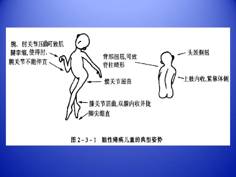 小儿脑瘫康复.pdf_第3页