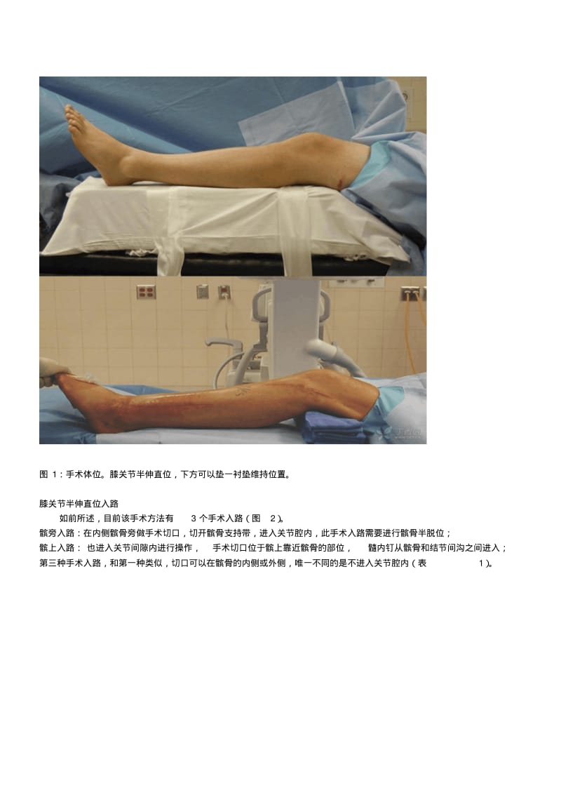 AAOS骨科教程：膝关节半伸直位胫骨髓内钉技术.pdf_第2页