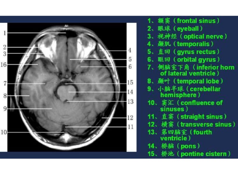 MRI常用解剖.pdf_第3页