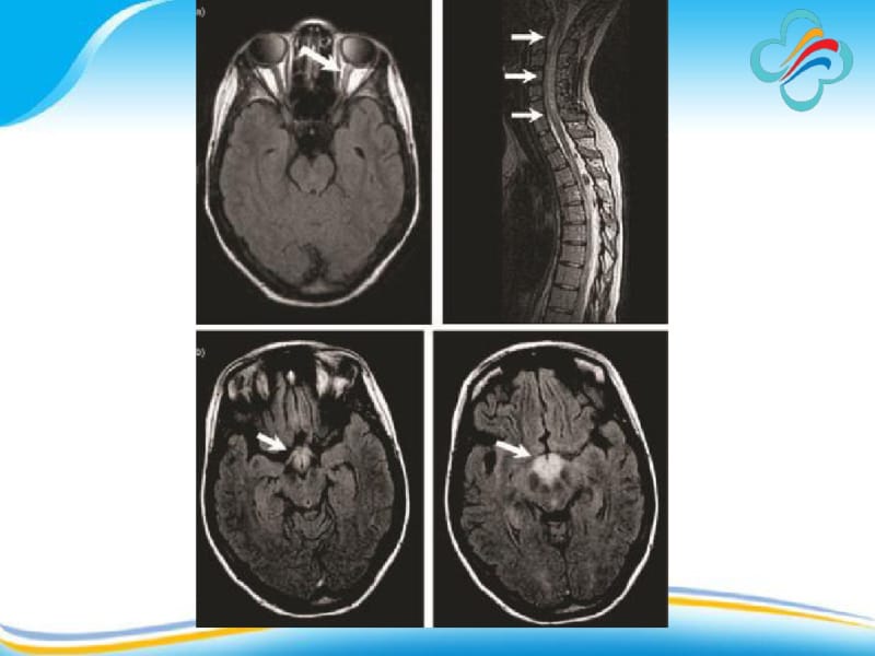 视神经脊髓炎与多发性硬化-.pdf_第3页