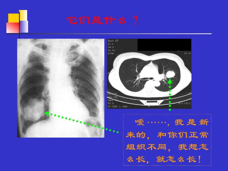 原发性支气管肺癌(1).pdf_第2页