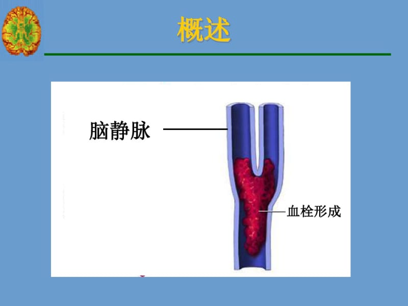 脑静脉系统血栓形成.pdf_第3页