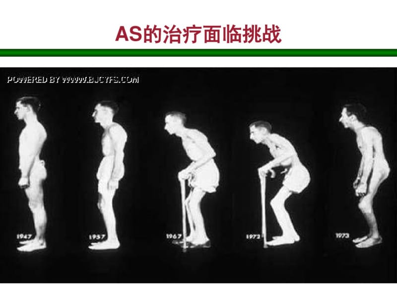 益赛普治疗强直性脊柱炎.pdf_第2页