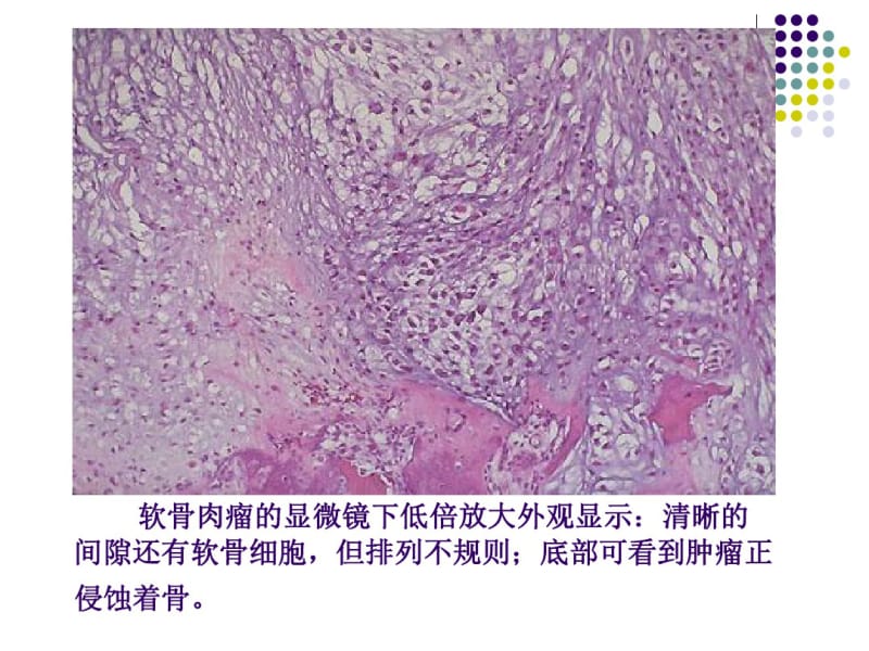 软骨肉瘤的病理及影像学表现.pdf_第3页