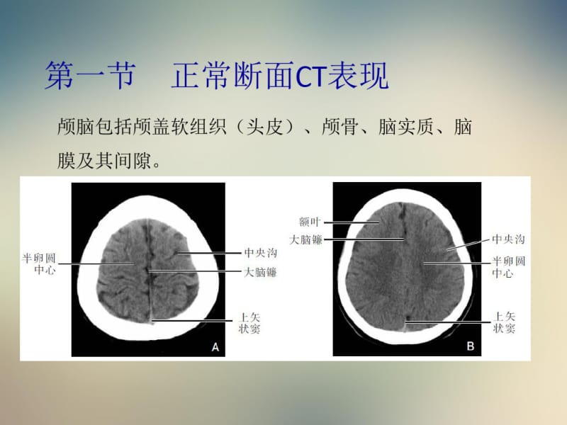 颅脑CT影像学表现.pdf_第2页