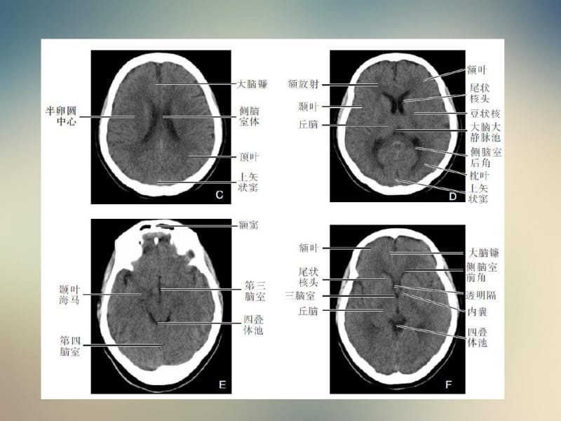 颅脑CT影像学表现.pdf_第3页