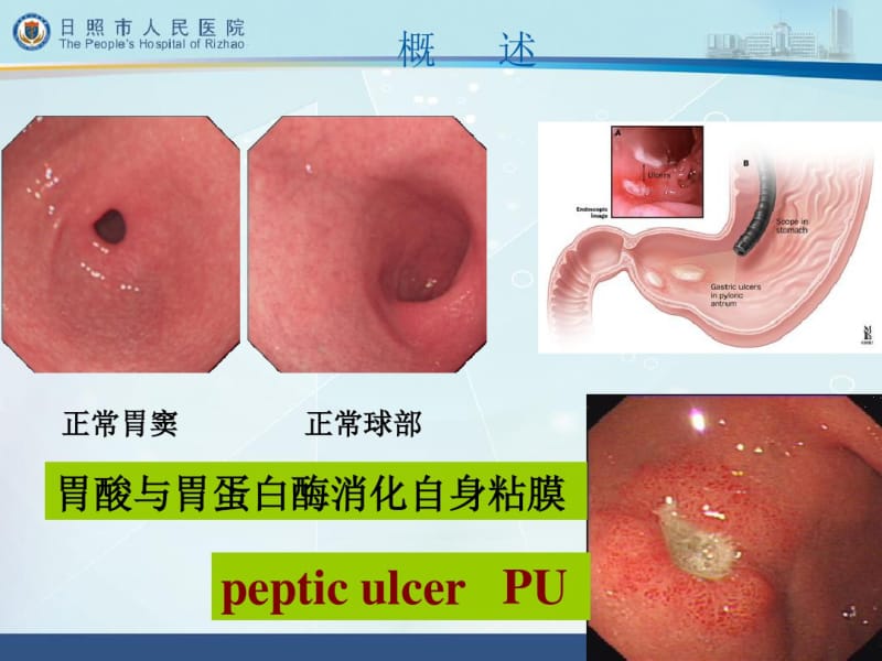 第八版--消化性溃疡课件.pdf_第3页