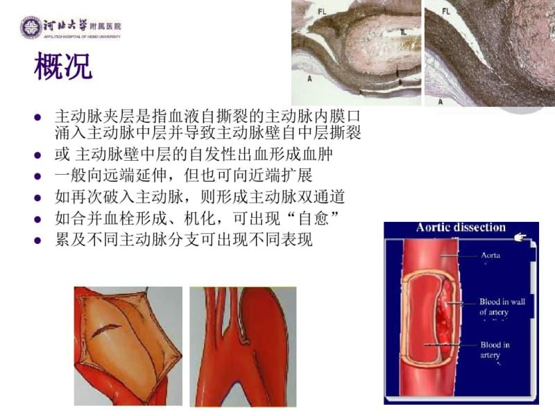 主动脉夹层的诊治-医学资料.pdf_第2页