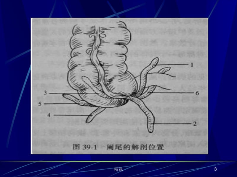 阑尾炎-(-appendicitis-)课件.ppt.pdf_第3页