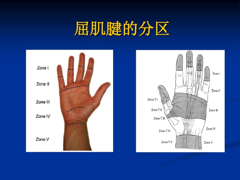 手部肌腱损伤讲解.pdf_第3页