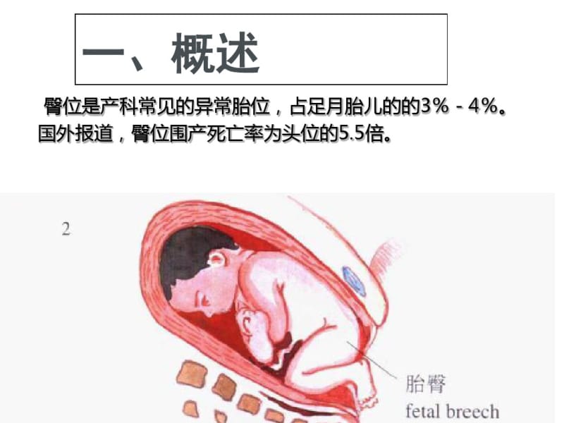 臀位分娩[1]-PPT文档资料.pdf_第2页