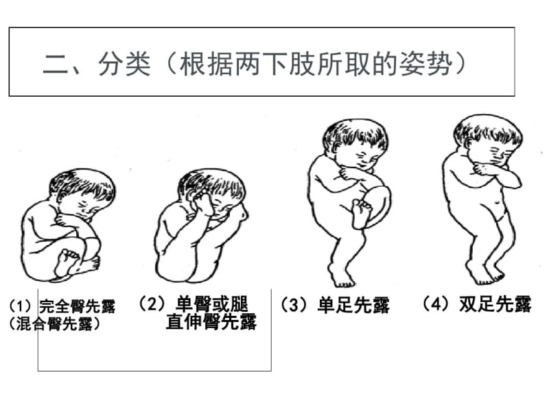 臀位分娩[1]-PPT文档资料.pdf_第3页