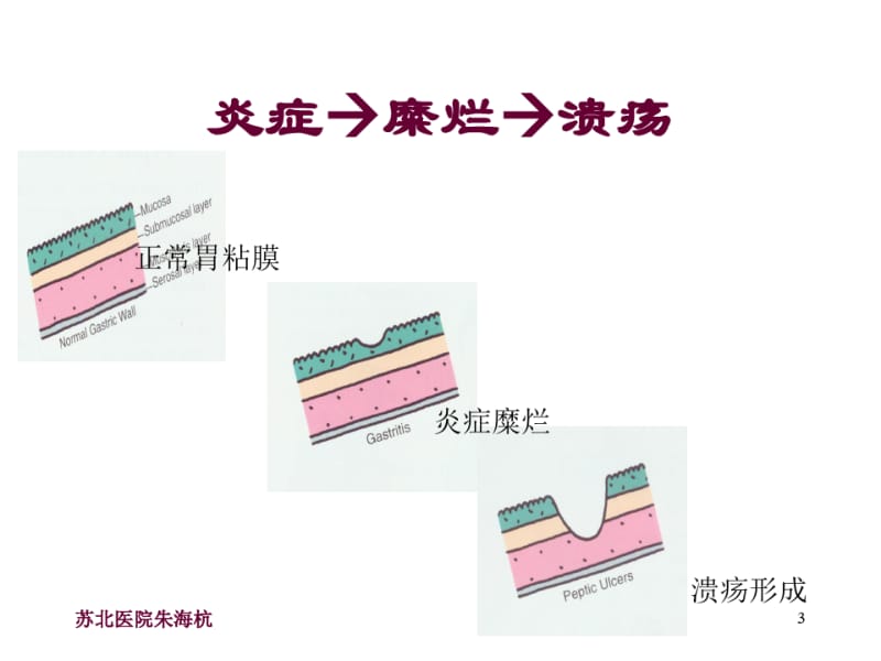 消化性溃疡(医学院).pdf_第3页