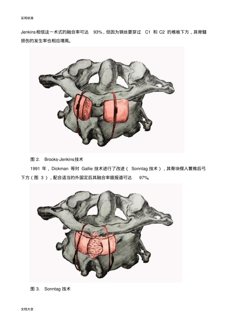 寰枢椎后路内固定术大汇总情况.pdf_第2页