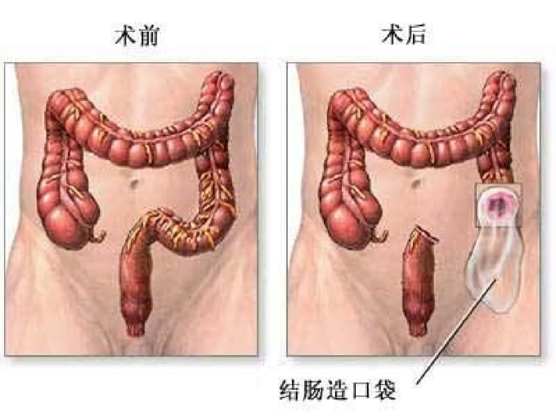 人工肛门的护理.pdf_第3页