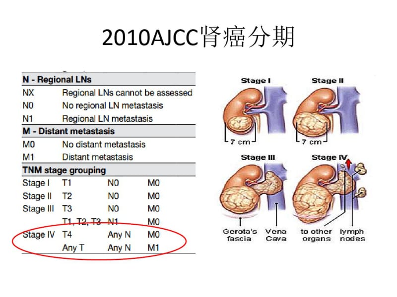 医学转移性肾癌靶向治疗现状和进展课件.pdf_第2页