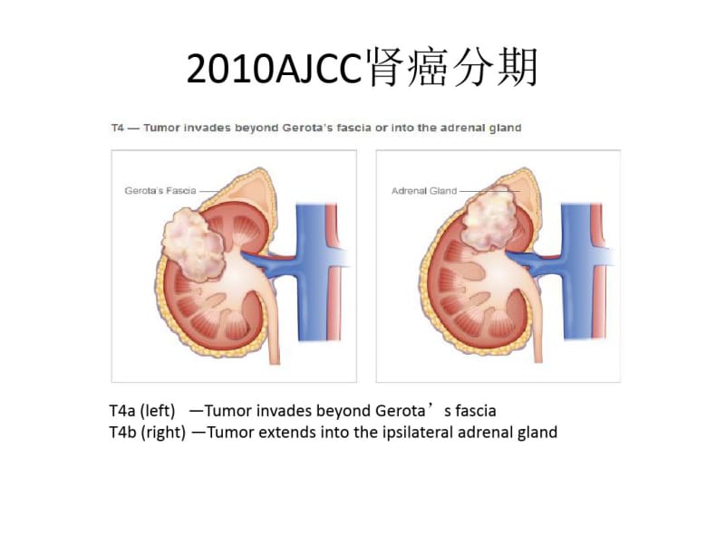 医学转移性肾癌靶向治疗现状和进展课件.pdf_第3页