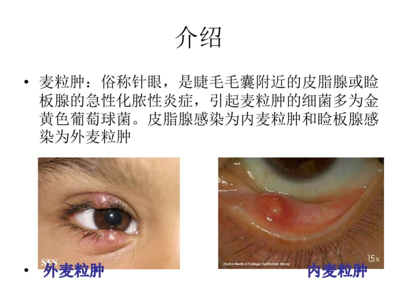 医学麦粒肿手术专题知识宣教课件.pdf_第2页