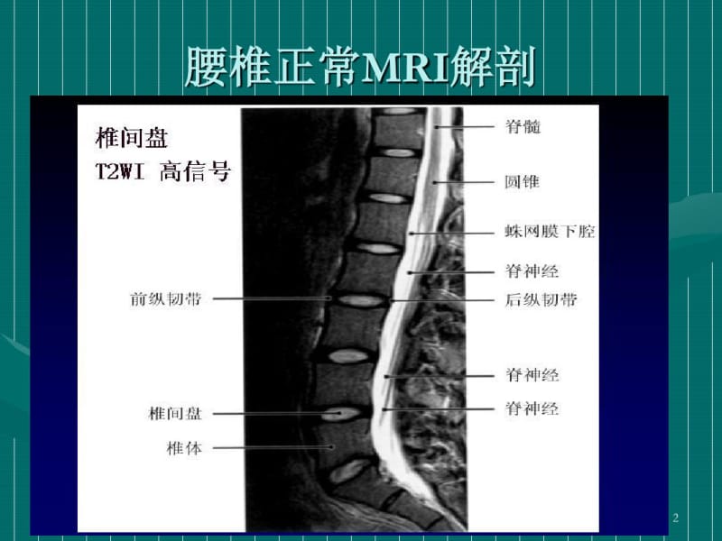 腰椎间盘的MRI诊断课件.pdf_第2页