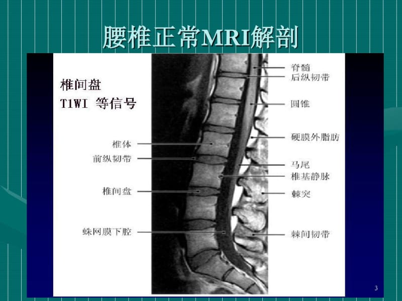 腰椎间盘的MRI诊断课件.pdf_第3页