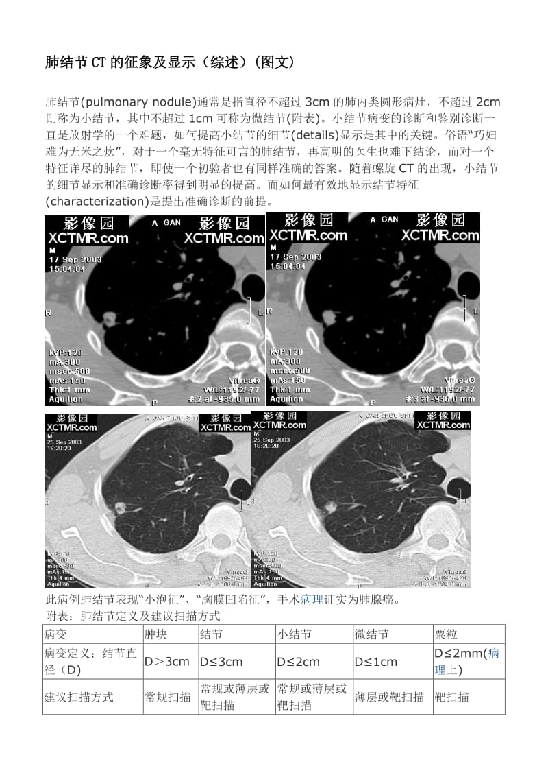 肺结节CT的征象及显示.doc_第1页